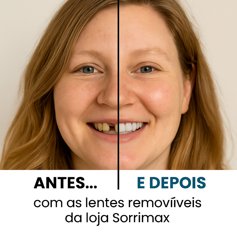 Lente Dental removível- Kit Superior + inferior  [compre 1 LEVE 2] pv2